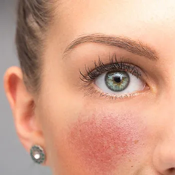 Rosacea: Symptoms, Causes, Triggers & Recommended Treatment