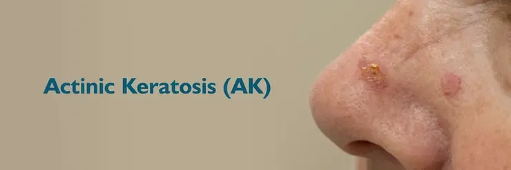 Rough, Scaly Skin Patches?