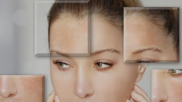 Melasma: Causes, Triggers & Treatments in Burlington