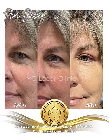 Experience the Power of Plexrplasty Soft-Surgery with Plexr Plasma