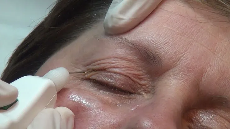 Blepharoplasty Using Plasma Technology