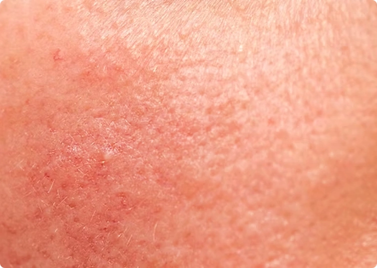 Rosacea & Redness img